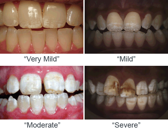 fluoride and white spots on teeth