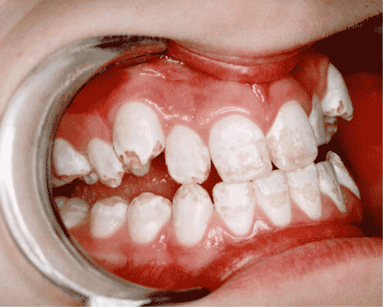 missing enamel on baby teeth