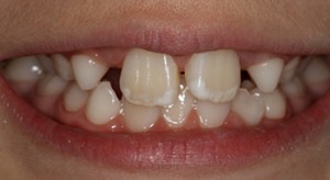 Dental Fluorosis (Photo by Dr. Jay Levy)